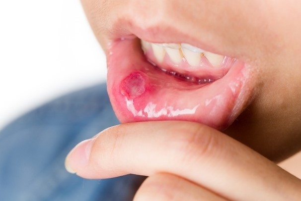 Doctors Review 7 Dangerous Diseases You Can Get Through Kissing